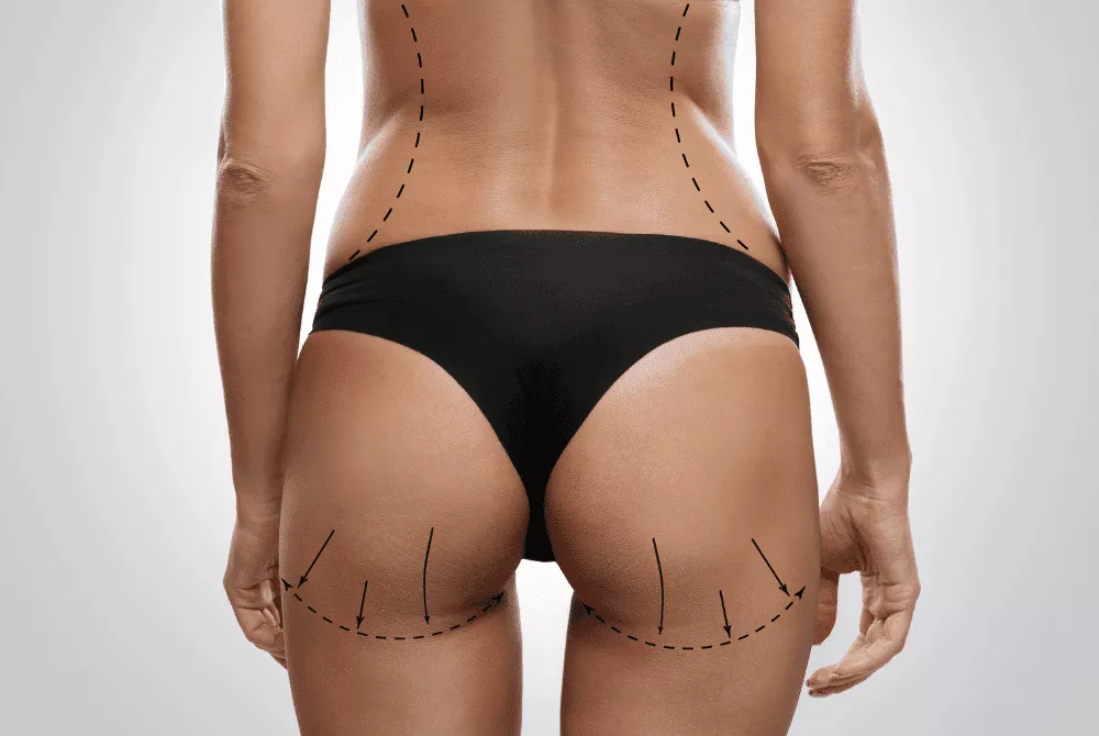 FINETUNE Medspa Sculptra Butt Lift Friscoi 1